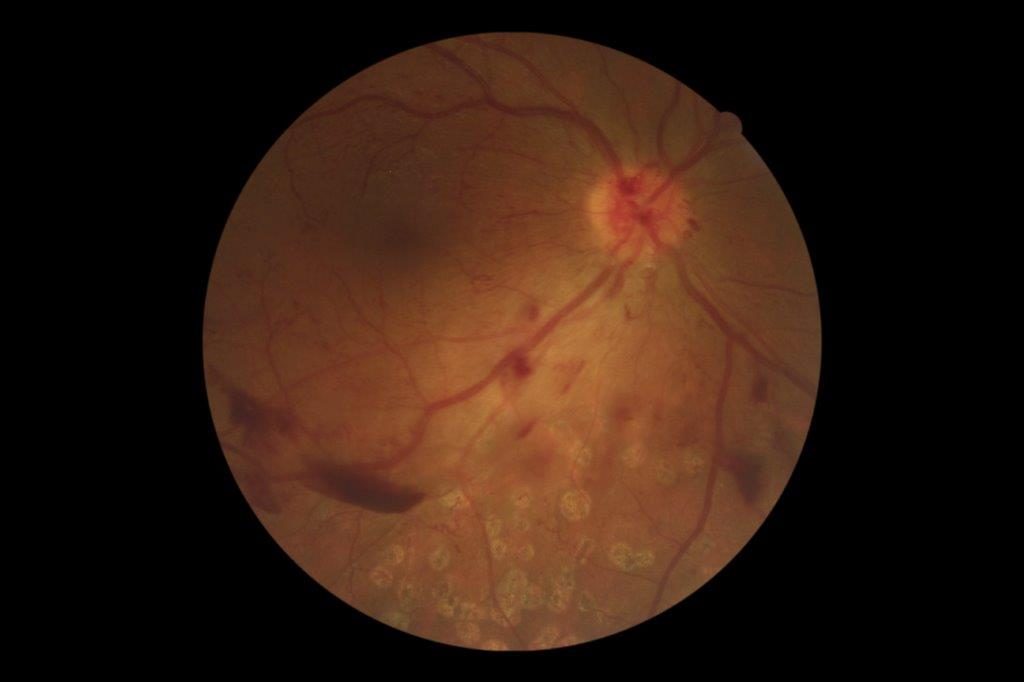 Diabetic Retinopathy Screening